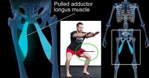 Adductor Strain: Causes, Symptoms, and Effective Treatment. Preventing